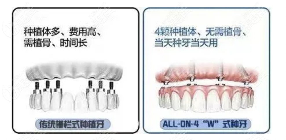 半口种植牙使用感受怎么写啊