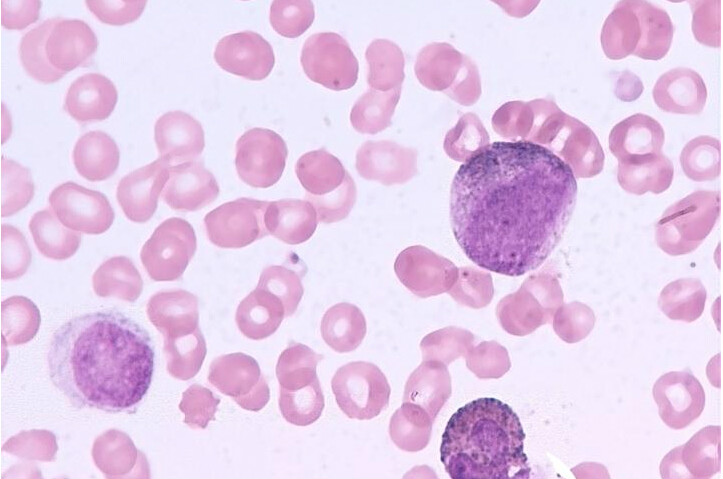 全称 a target="_blank" href="/item/慢性淋巴细胞性白血病/4877589"