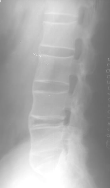  p> a target="_blank" href="/item/强直性脊柱炎">强直性脊柱炎 /a>