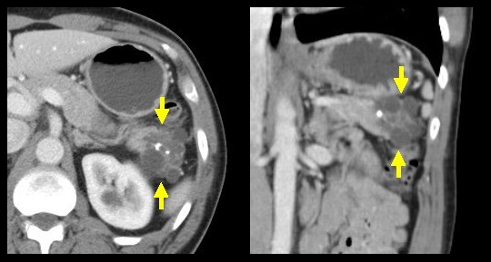  p>胰腺囊腺瘤和囊腺癌,英文名:cystadenoma and cystadenocarcinoma