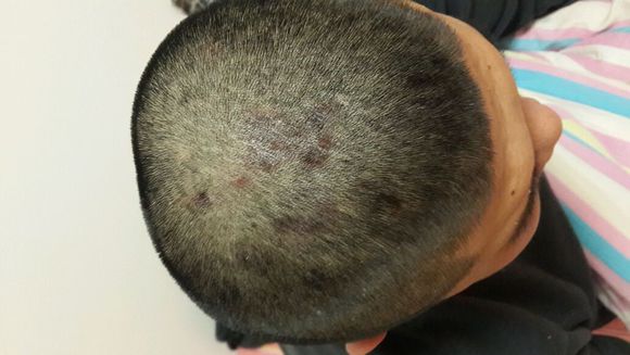 头部脂溢性皮炎