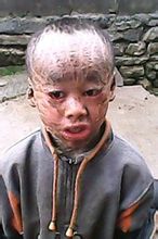  p>"建鱼行动"是我国唯一一个针对"鱼鳞病"设立的大型救助公益活动.