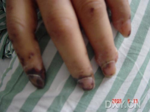  p>janeways结(janeway spot),詹韦氏斑,又称詹韦氏损害,是一个病症