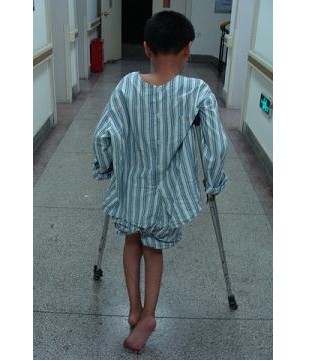 痉挛型小儿脑瘫