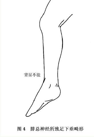 发疹性毳毛囊肿腓总神经卡压症