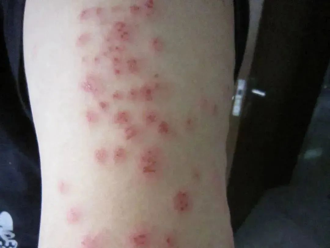 警惕这种虫子！多国爆发床虱危机，以人类血液为食，已蔓延至亚洲_百科TA说