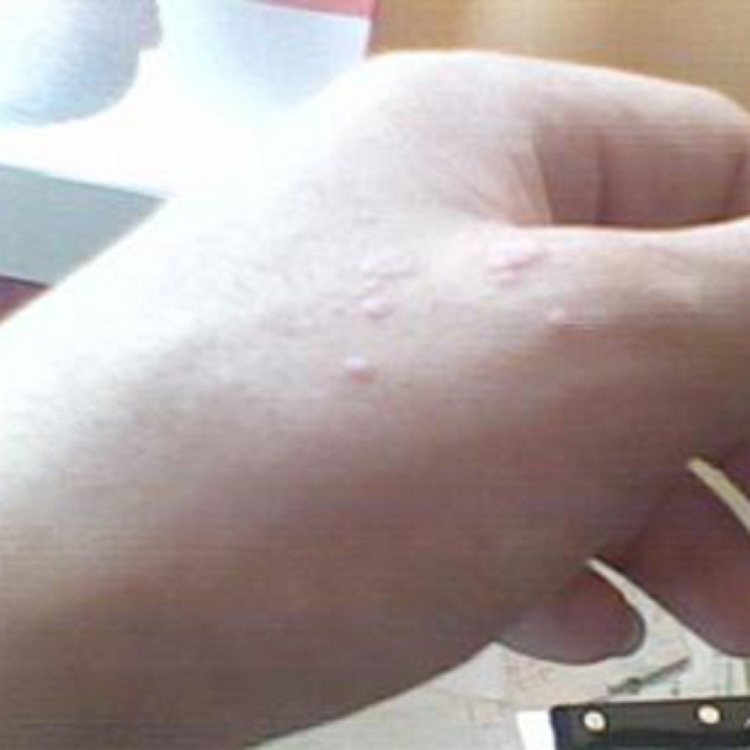  p>鱼痣即鱼鳞痣,究其本质不是一种痣,其实是一种 a target="_blank"