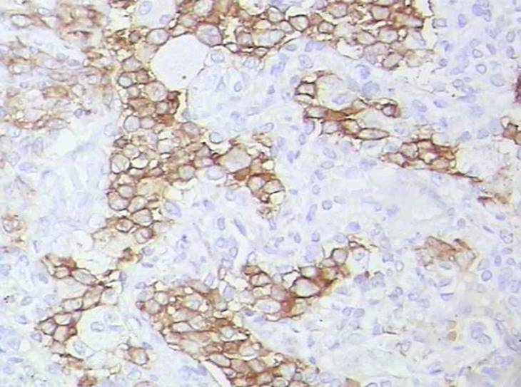 朗格汉斯细胞组织增生症