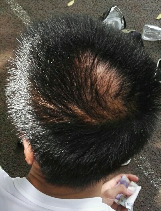 青少年脱发