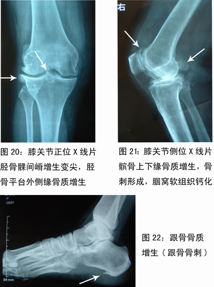 骨关节骨质增生