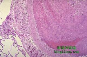 血液回流障碍,产生肝大及疼痛,腹水,肝脏功能障碍等一系列临床表现