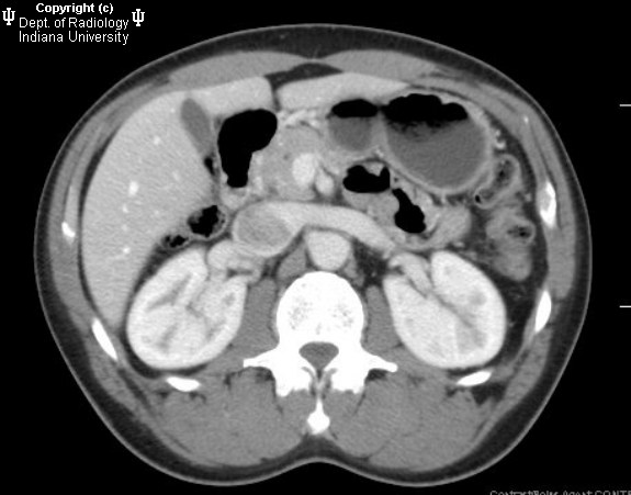  p>胰腺囊腺瘤和囊腺癌,英文名:cystadenoma and cystadenocarcinoma