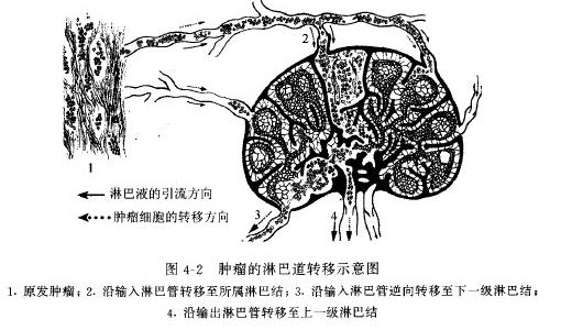  p data-id="gnazfn1lq3">淋巴道转移(lymphatic metastasis)是癌