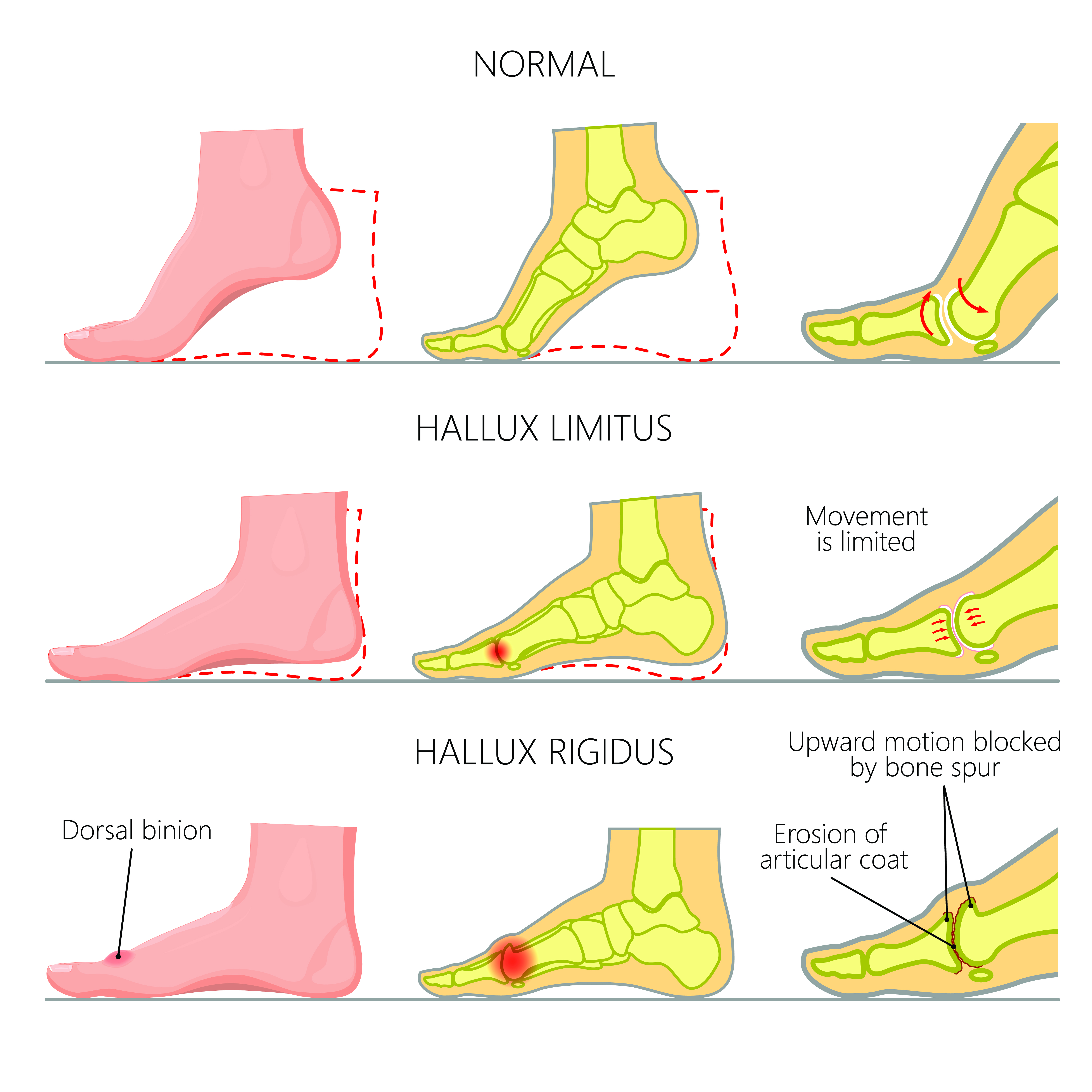  p data-id="gnaymblejg">拇僵硬(hallux rigidus)是一种累及第一跖趾