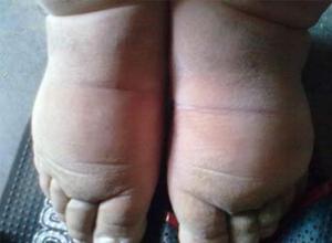 药物而引起的体液平衡紊乱,体液潴留于组织间隙而出现全身或局部肿胀