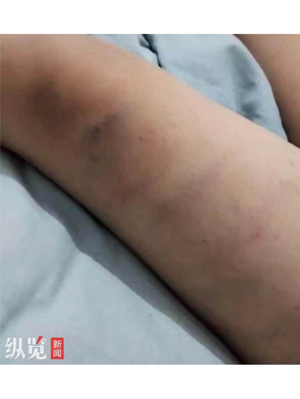 恩施市英才学校就读六年级的孩子,遭到数学老师殴打致身上多处淤青