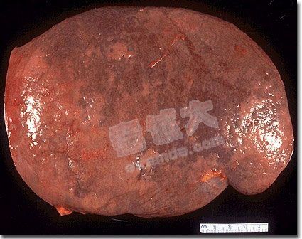 脾肿大 全网资源