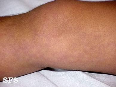 " data-lemmaid="8849994">肉眼 /a>就能看见一条条扩张的毛细血管