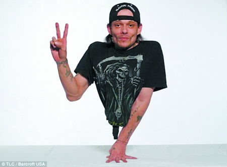 是美国出名的"半身人",患有一种罕见的"骶骨发育不全症". /p>