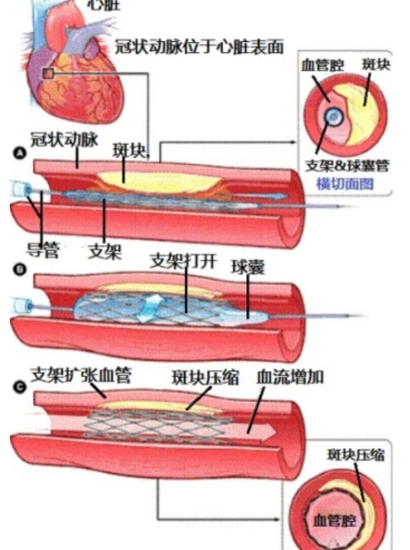 冠状动脉栓塞