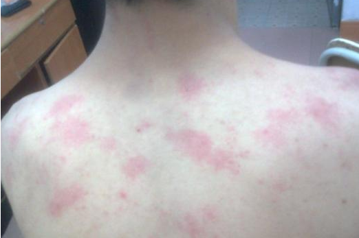胆碱荨麻疹