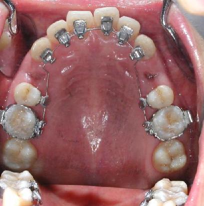 它是将矫治器全部安装于牙齿的舌侧面进行正畸治疗,外观上看不到任何