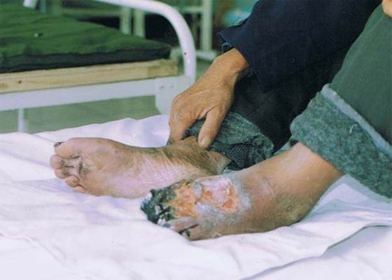 糖尿病末梢神经炎