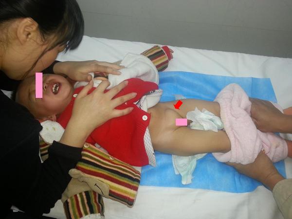 上分原发 a target="_blank" href="/item/睾丸鞘膜积液/10028962"