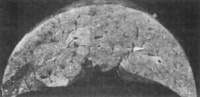 data-lemmaid="733157">血吸虫病 /a>引起的肝硬化病理特点为不完全