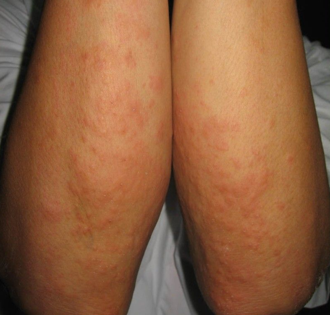  p>日光性皮炎又称急性日晒伤,晒斑,是皮肤接受强烈光线照射引起的一