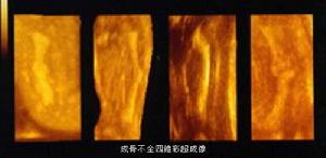 病症表现为骨质脆弱, a target="_blank" href="/item/蓝巩膜">蓝巩膜
