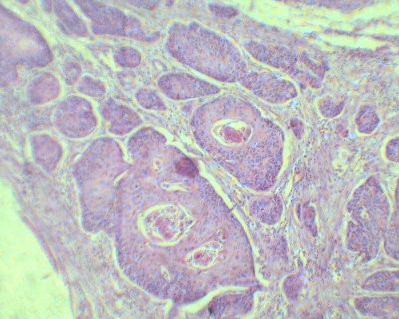 p>非典型鳞状细胞是由于子宫颈发炎而引致细胞变异而形成的一种细胞