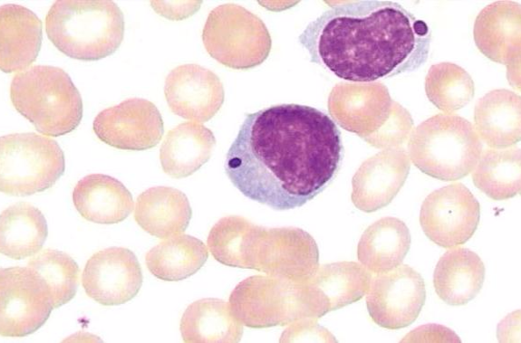  p>淋巴细胞(lymphocyte)是白细胞的一种,是体积最小的白细胞.