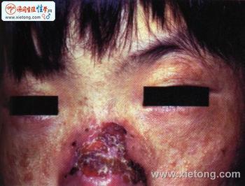 生成卟啉症比较常见的一种是急性间歇型卟啉症(aip),使患者严重贫血