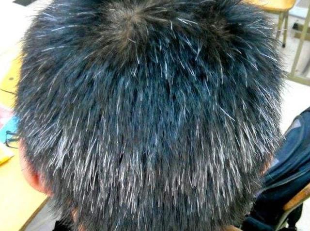 西医称之为早老性 a target="_blank" href="/item/白发病/4744794"