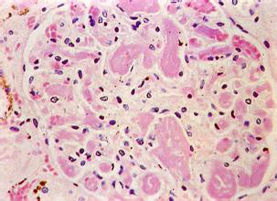  p>白色血栓(pale thrombus),又称为血小板血栓或析出性血栓.