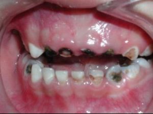 龋齿 /a>,医学上称为奶瓶龋(又称哺乳龋),表现为上颌乳切牙(即门牙)的