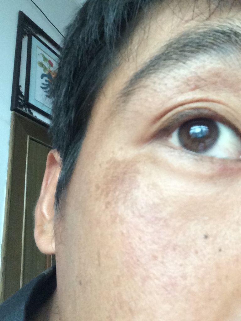 这种黑色素沉积异常的色素沉着可以影响人体皮肤美观,影响容貌
