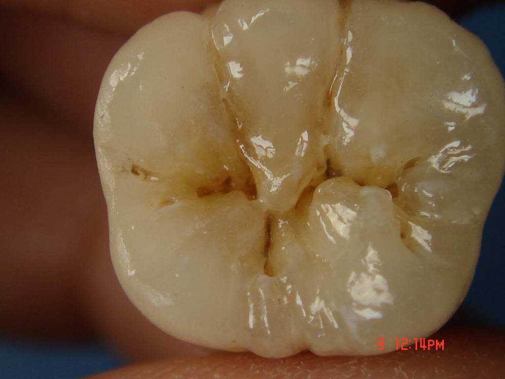 有些龋损的釉质表面无明显破坏,具有这类临床特征的龋损又称潜行性龋.