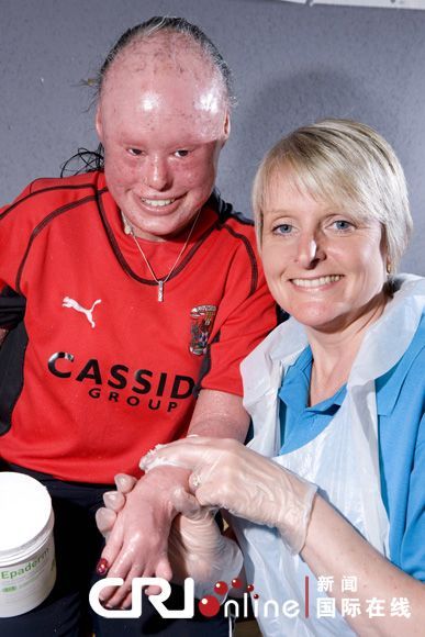 斑色鱼鳞癣harlequin ichthyosis (hi),也称为ichthyosis fetalis,为