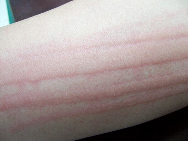  p>皮肤划痕症也称 a target="_blank" href="/item/人工性荨麻疹