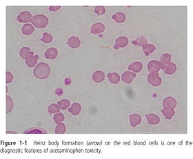 变性珠蛋白小体