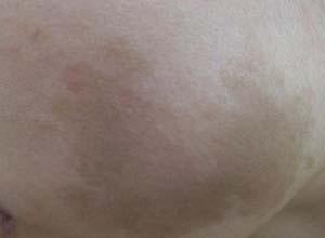 数目较多的咖啡牛奶斑