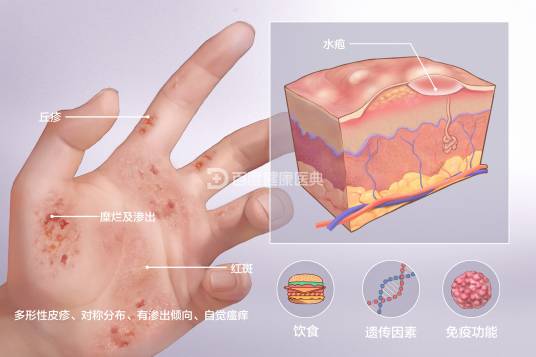 湿疹（皮肤炎症反应）_百度百科