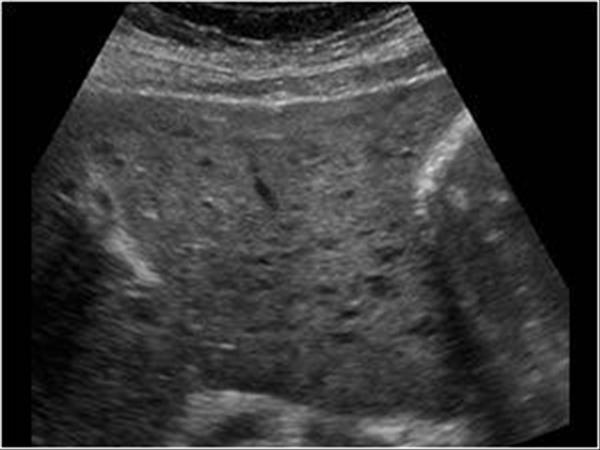 " data-lemmaid="56043489">弥漫性 /a>病变是指肝脏组织病变在 a