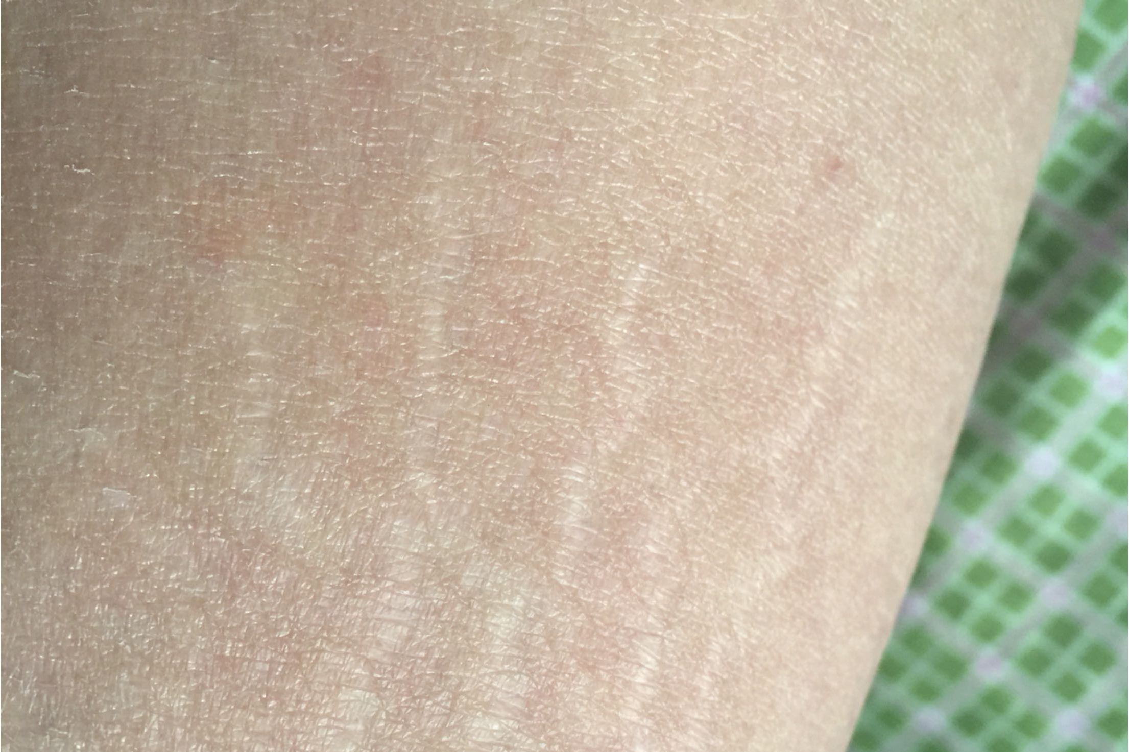 生长纹一般出现于体重增加过快的人身上,因皮下脂肪增长太快,皮肤生长