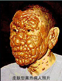 皮肤型黑热病