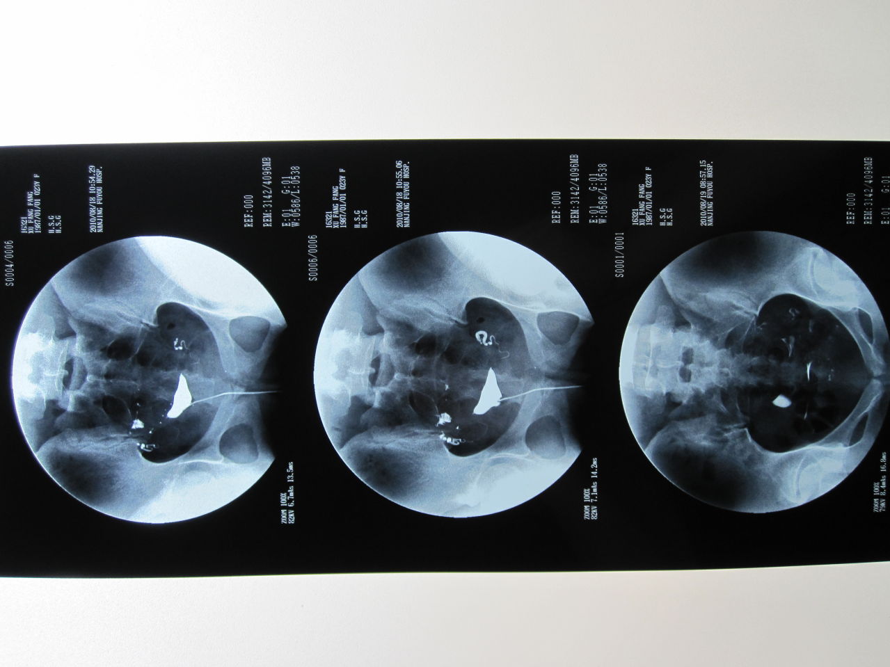 target="_blank" href="/item/子宫输卵管造影/1795007" data-lemmaid