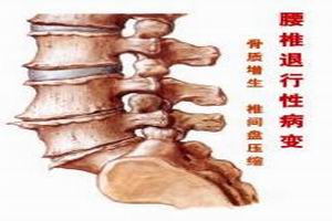 骨质软化症(ricketsandosteomalacia)是以新近形成的骨基质矿化障碍为