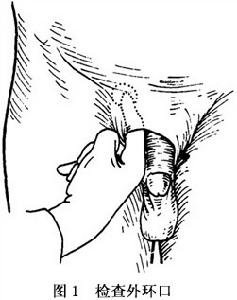 adult inguinal hernia